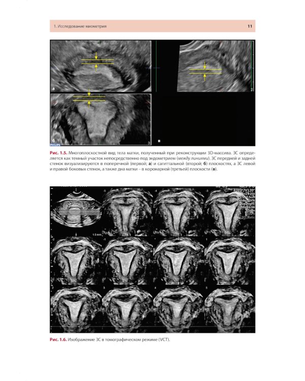 Стандартизация ультразвукового исследования миометрия и эндометрия (MUSA, IETA): Учебное пособие. 2-е изд