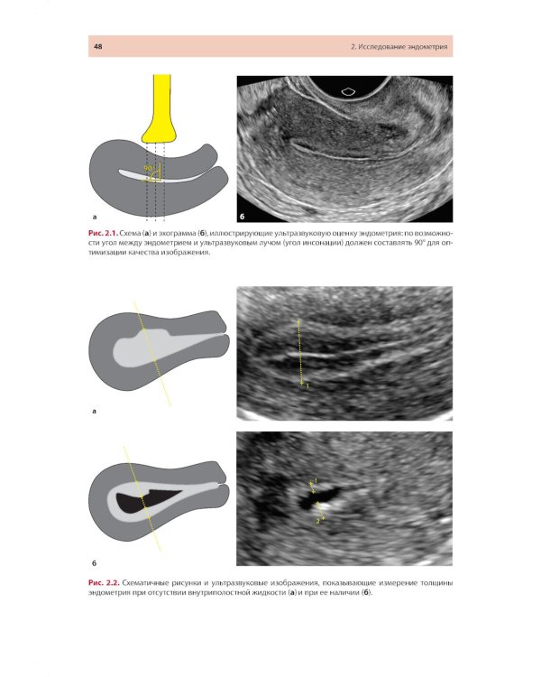 Стандартизация ультразвукового исследования миометрия и эндометрия (MUSA, IETA): Учебное пособие. 2-е изд