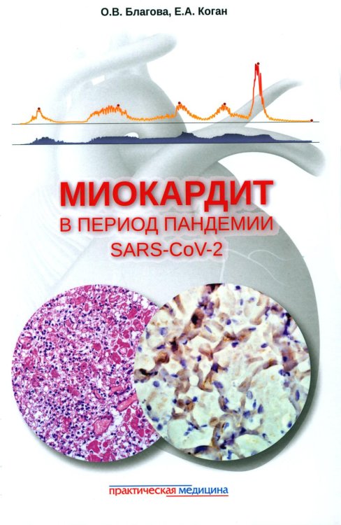 Миокардит в период пандемии SARS-CoV-2 Миокардит в период пандемии SARS-CoV-2