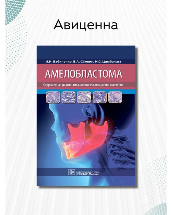 Амелобластома. Современная диагностика, клиническая картина и лечение