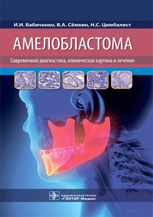 Амелобластома: современная диагностика, клиническая картина и лечение Амелобластома: современная диагностика, клиническая картина и лечение