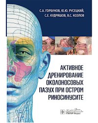 Активное дренирование околоносовых пазух при остром риносинусите