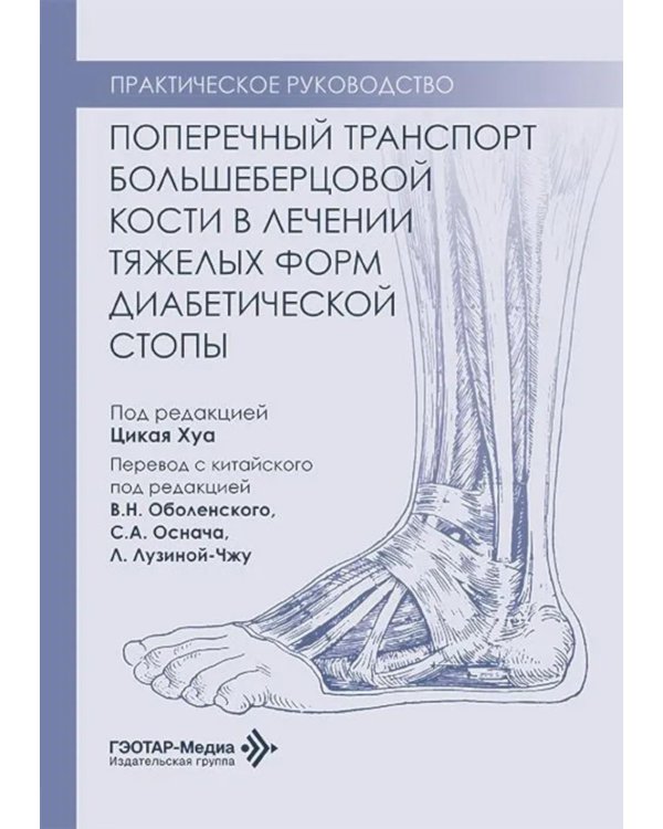 Поперечный транспорт большеберцовой кости в лечении тяжелых форм диабетической стопы. Практическое руководство