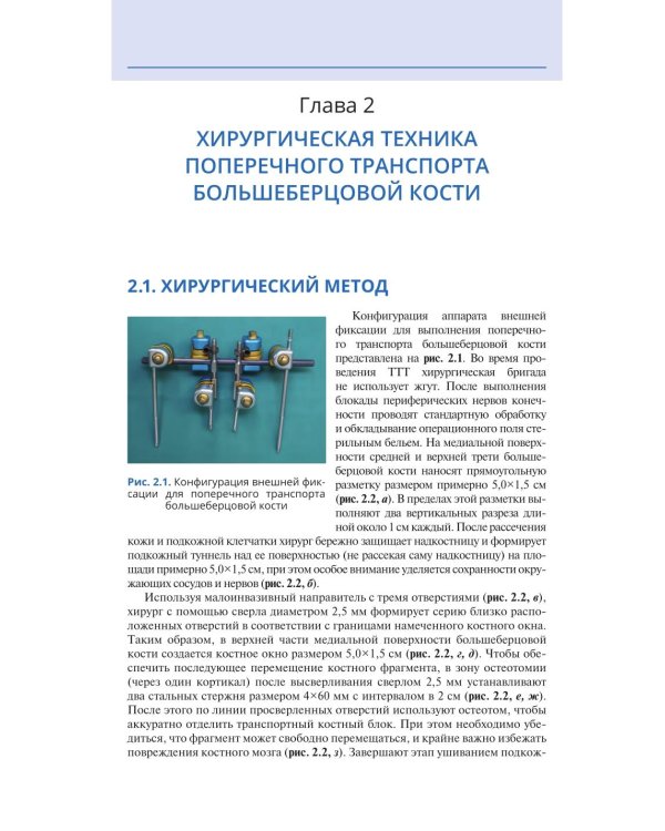 Поперечный транспорт большеберцовой кости в лечении тяжелых форм диабетической стопы. Практическое руководство