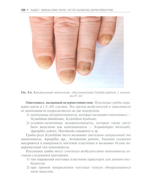 Поверхностные микозы
