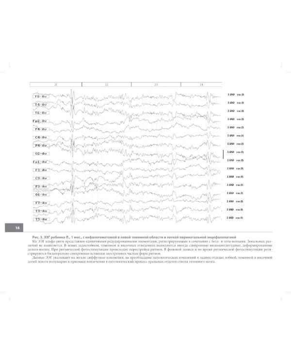 Атлас электроэнцефалограмм детей с различной патологией головного мозга. 2-е изд