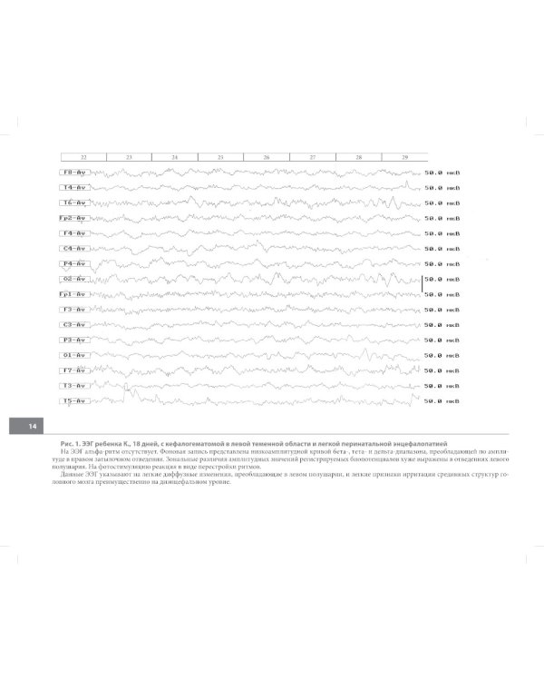 Атлас электроэнцефалограмм детей с различной патологией головного мозга. 2-е изд