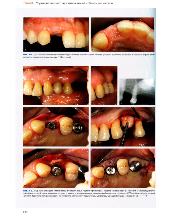 Эстетика мягких тканей в имплантологии
