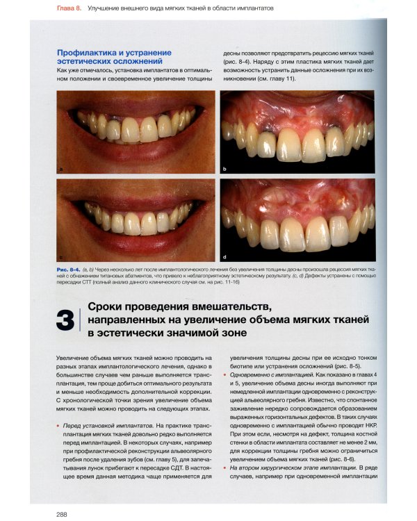 Эстетика мягких тканей в имплантологии
