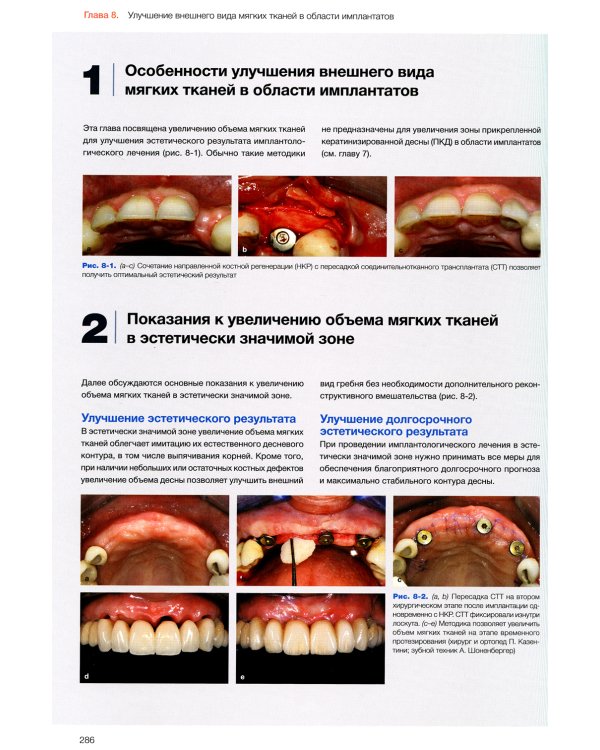 Эстетика мягких тканей в имплантологии