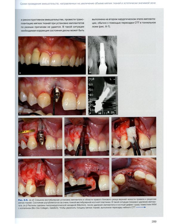 Эстетика мягких тканей в имплантологии
