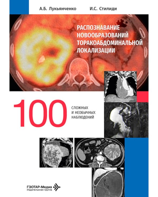Распознавание новообразований торакоабдоминальной локализации: 100 сложных и необычных наблюдений