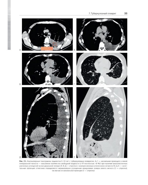 Распознавание новообразований торакоабдоминальной локализации: 100 сложных и необычных наблюдений