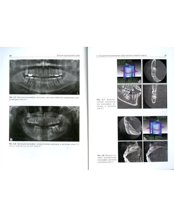 Болезни прорезывания зубов: Учебное пособие