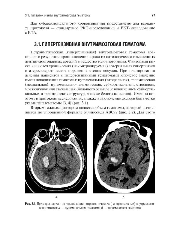Ишемический инсульт и нетравматическое внутричерепное кровоизлияние: формализованные протоколы описания РКТ- и МРТ-исследований: Учебное пособие