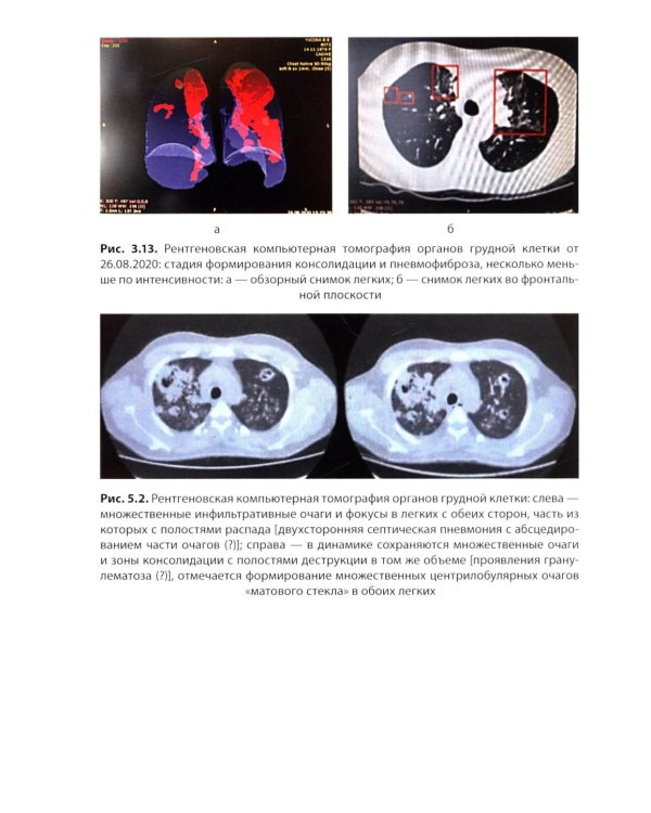 COVID-19 и постковидный синдром у больных ревматологического профиля: руководство для врачей