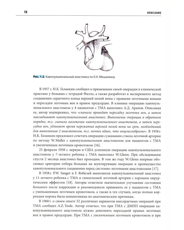 Транспозиция магистральных артерий