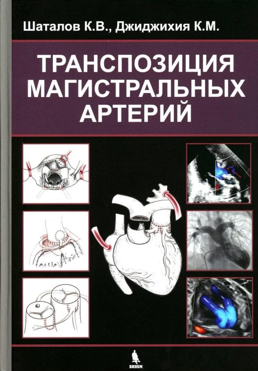 Транспозиция магистральных артерий