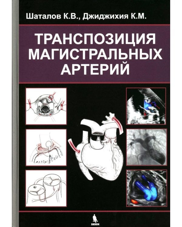 Транспозиция магистральных артерий