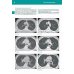 Рентгенологическое исследование грудной клетки. Практическое руководство. Атлас. 2-е изд., перераб.и доп Рентгенологическое исследование грудной клетки. Практическое руководство. Атлас. 2-е изд., перераб.и доп
