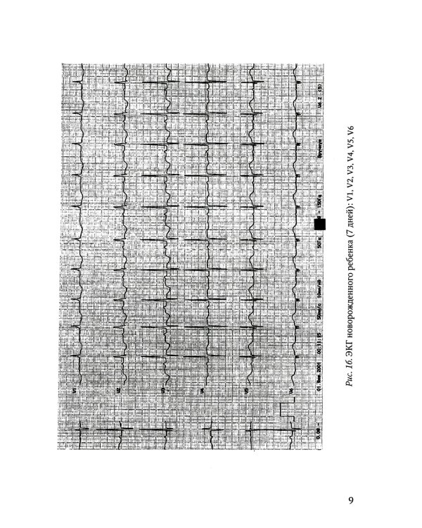 Анализ электрокардиограммы у детей раннего возраста с врожденными пороками сердца: Учебное пособие