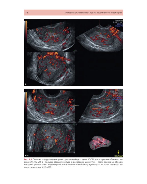 Ультразвуковая оценка рецептивности эндометрия: методические рекомендации