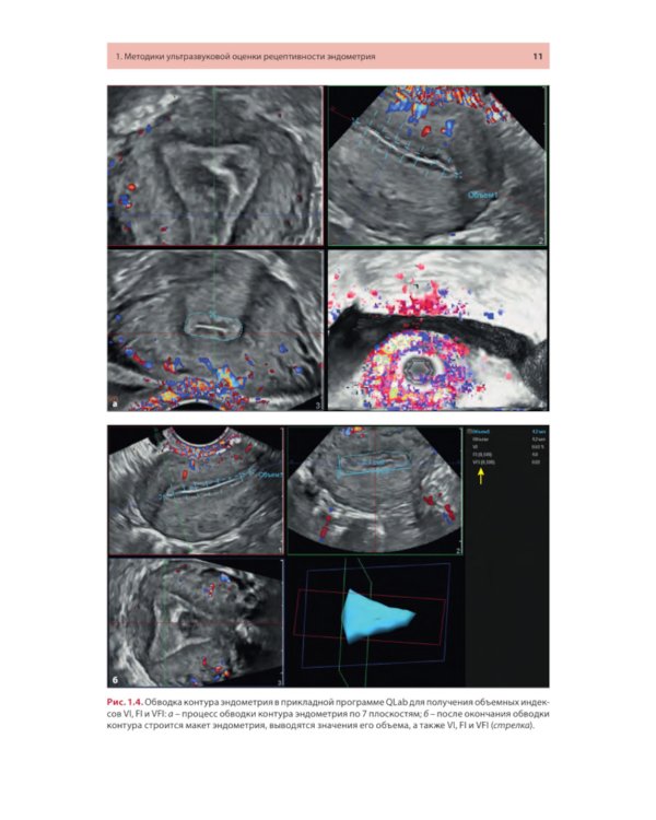 Ультразвуковая оценка рецептивности эндометрия: методические рекомендации
