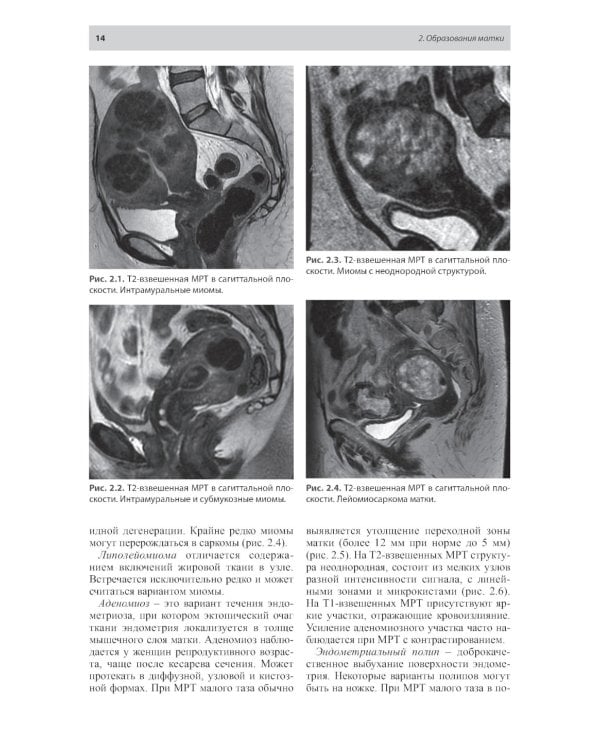 Тазовые боли у женщин. Дифференцианальная диагностика лучевыми методами