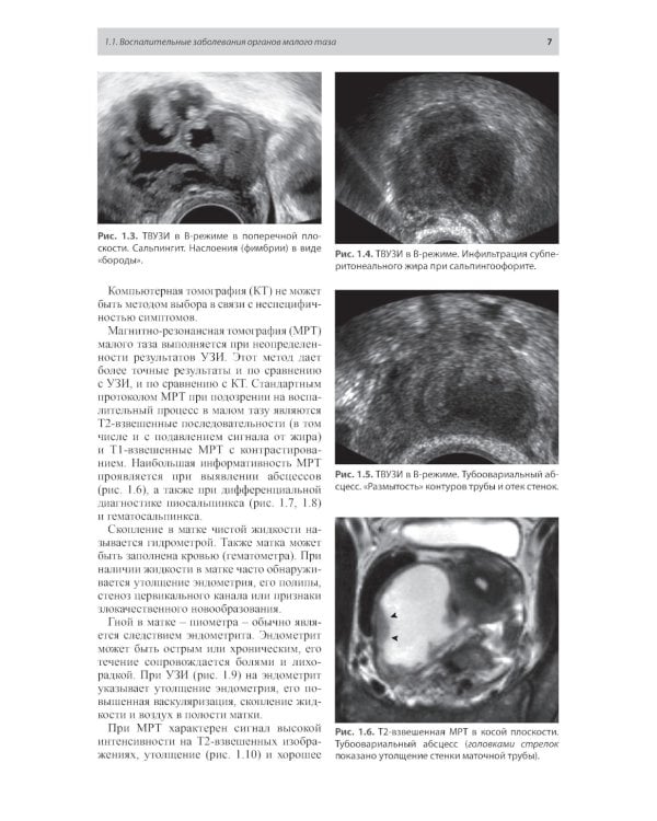 Тазовые боли у женщин. Дифференцианальная диагностика лучевыми методами