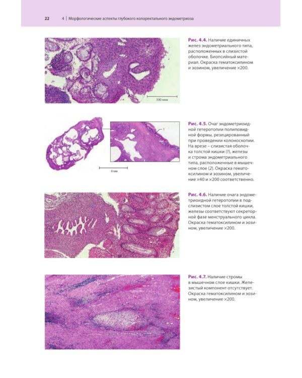 Атлас по эндоскопической диагностике колоректального эндометриоза