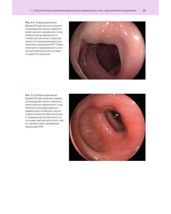 Атлас по эндоскопической диагностике колоректального эндометриоза