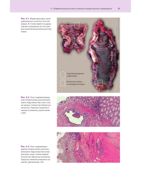 Атлас по эндоскопической диагностике колоректального эндометриоза