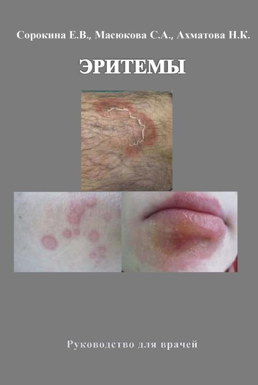 Жить здорово Эритемы. Руководство для врачей