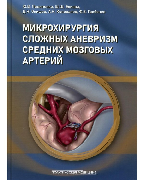 Микрохирургия сложных аневризм средних мозговых артерий: гигантских, фузиформных и частично тромбированных