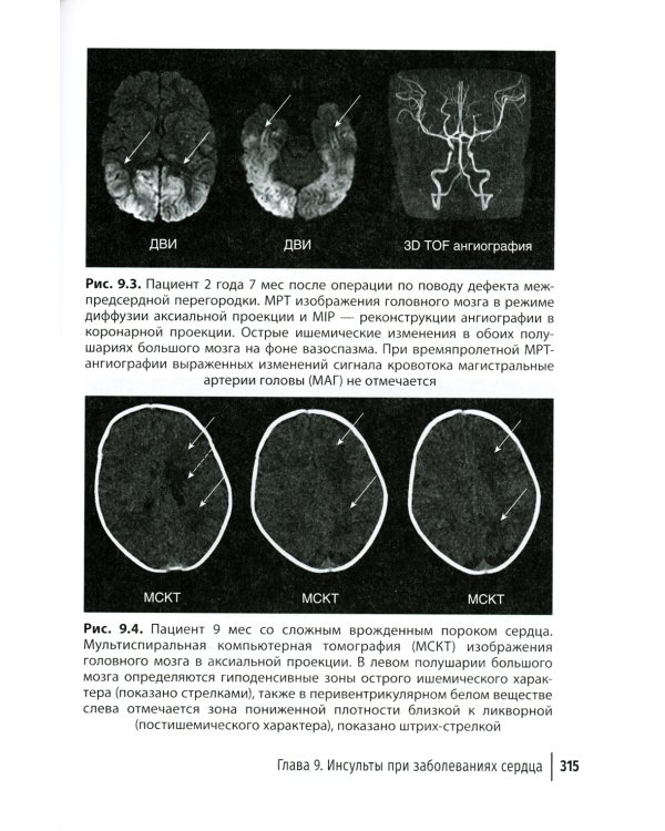 Инсульт и цереброваскулярная патология у детей и подростков: руководство для врачей