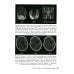 Инсульт и цереброваскулярная патология у детей и подростков: руководство для врачей