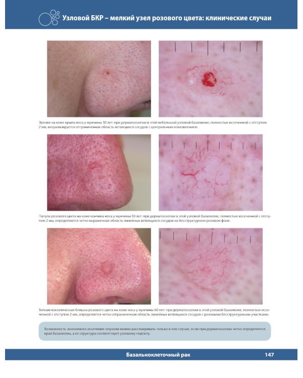 Диагностическая дерматоскопия: иллюстрированное руководство. 2-е изд