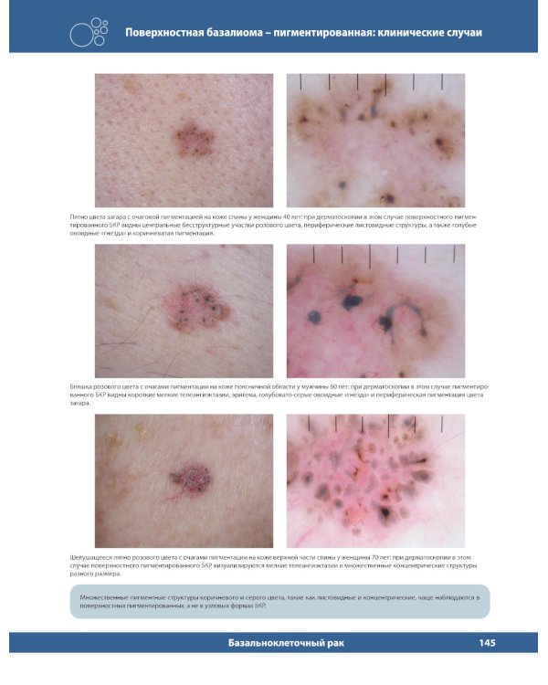 Диагностическая дерматоскопия: иллюстрированное руководство. 2-е изд