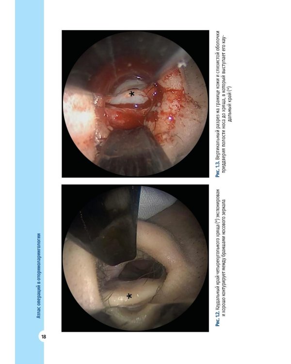 Атлас операций в оториноларингологии