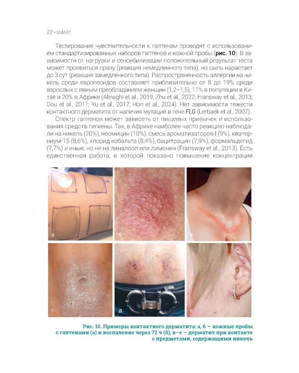 Атопический дерматит. Генетика, патогенез и терапия. 2-е изд., перераб. и доп