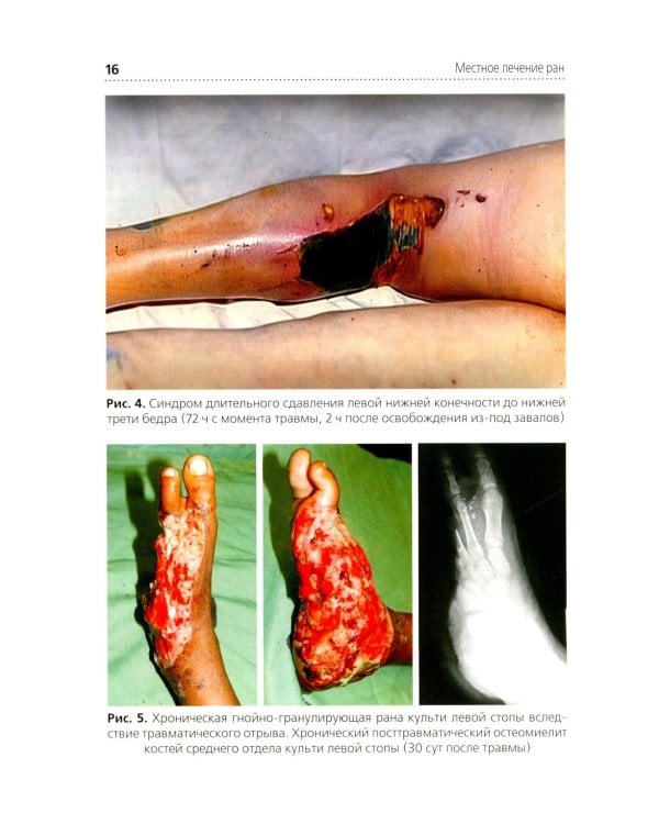 Местное лечение ран: Учебное пособие