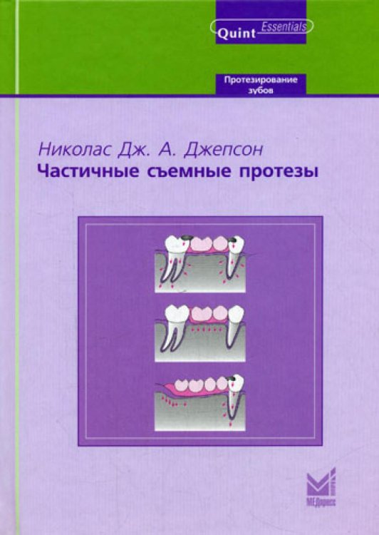 Частичные съемные протезы Частичные съемные протезы