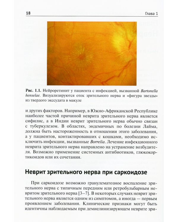 Нейроофтальмология. Мировые тенденции в диагностике и лечении