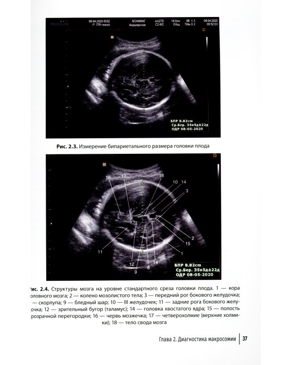 Ультразвуковая диагностика диабетической фетопатии