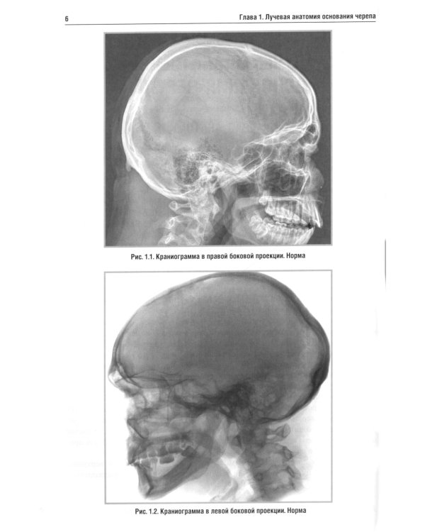 Лучевая диагностика заболеваний оснований черепа и мостмозжечкового угла: Учебное пособие