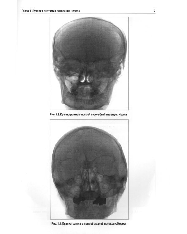 Лучевая диагностика заболеваний оснований черепа и мостмозжечкового угла: Учебное пособие