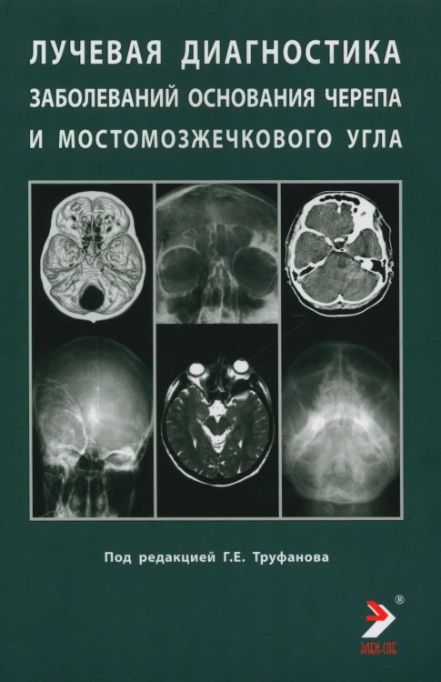 Лучевая диагностика заболеваний оснований черепа и мостмозжечкового угла: Учебное пособие Лучевая диагностика заболеваний оснований черепа и мостмозжечкового угла: Учебное пособие