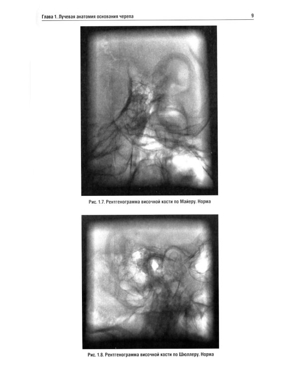 Лучевая диагностика заболеваний оснований черепа и мостмозжечкового угла: Учебное пособие