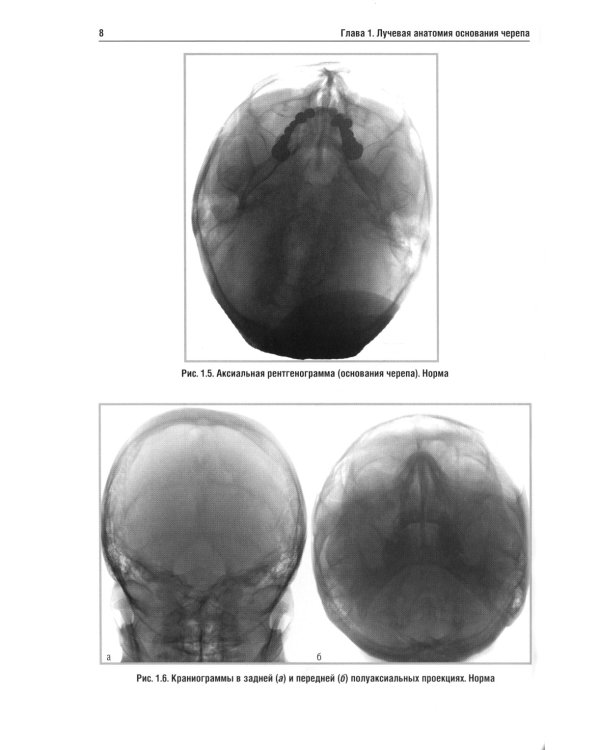 Лучевая диагностика заболеваний оснований черепа и мостмозжечкового угла: Учебное пособие