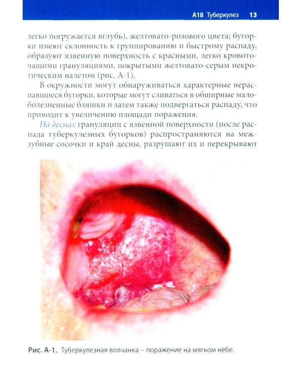 Заболевания слизистой оболочки рта. Связь с общей патологией. Диагностика. Лечение